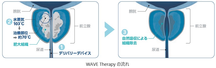 WAVE therapy の流れ