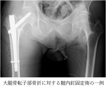 大腿骨転子部骨折に対する髄内釘固定術の一例