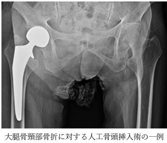 大腿骨頸部骨折に対する人工骨頭挿入術の一例