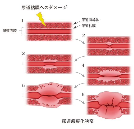 尿道狭窄症image01