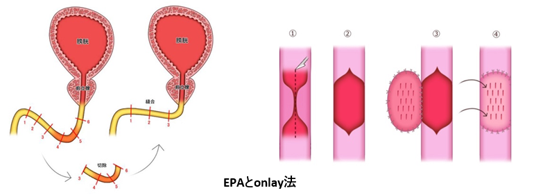 尿道形成術image01