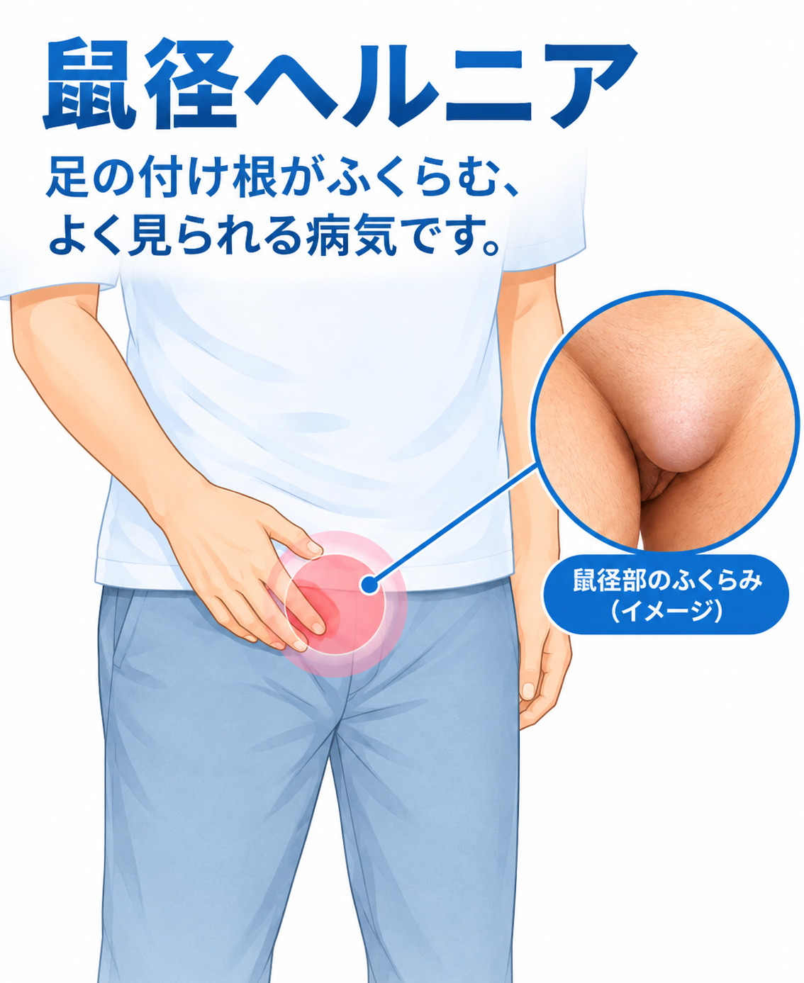 鼠径ヘルニア